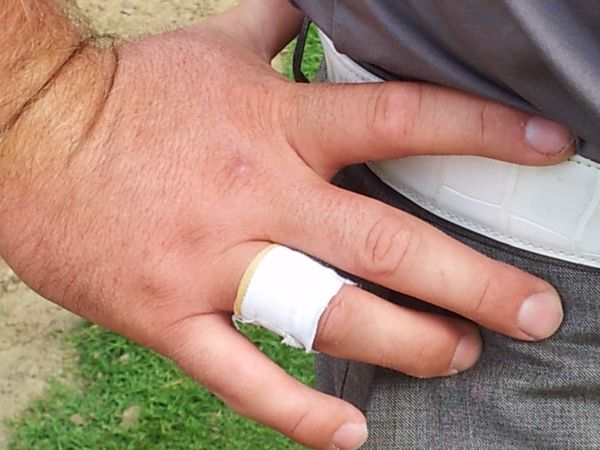 McDowell's injured finger (from atop) red