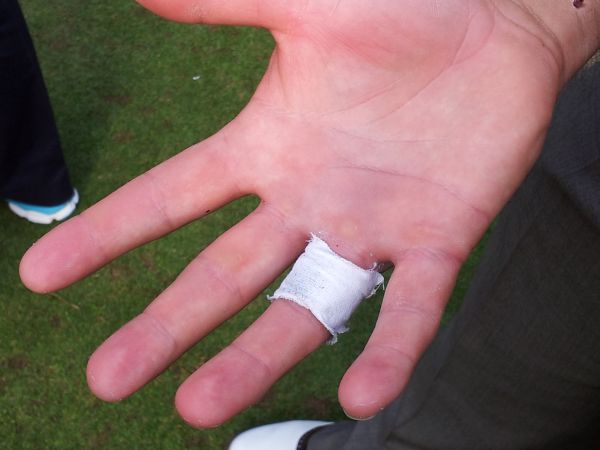 McDowell's injured finger (red)