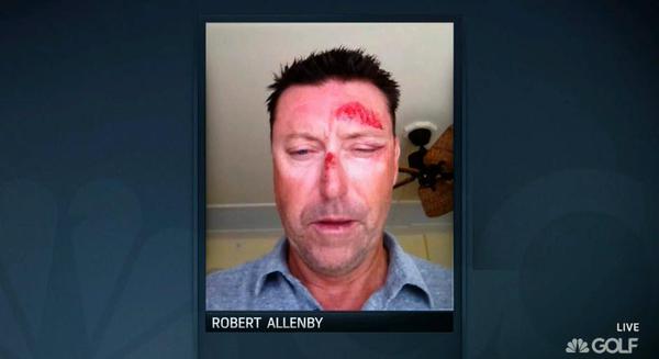 Robert Allenby showing the legacy of being bashed, kidnapped and robbed in Hawaii.